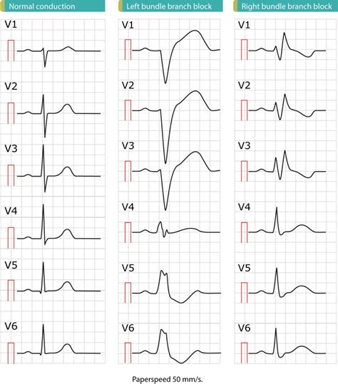 Figure 1. These ECGs show the difference between normal conduction ...