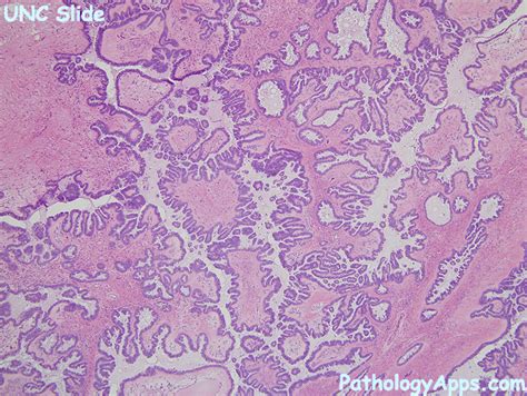 borderline serous tumor pathology