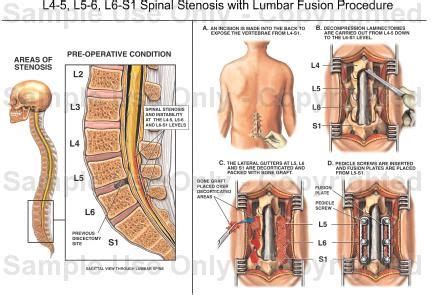 L4-5, L5-6, L6-S1 Spinal Stenosis with Lumbar Fusion Procedure | Spinal ...