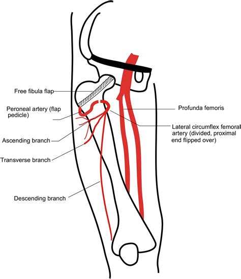 Medial Circumflex Femoral Artery Branches