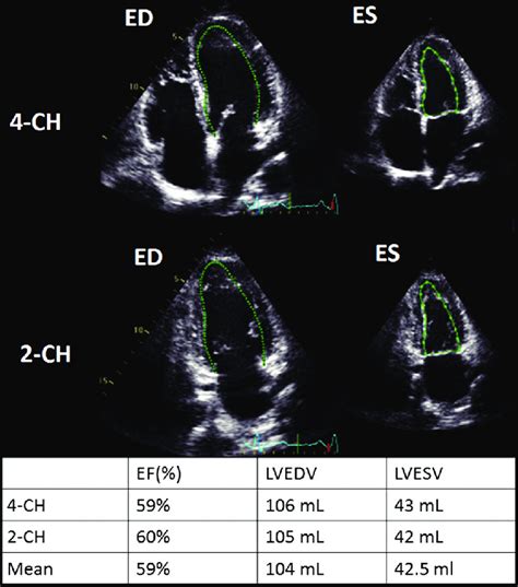 Automated assessment of left ventricle ejection fraction and volumes.... | Download Scientific ...