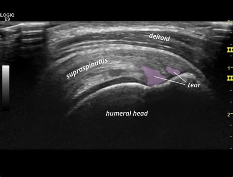 Tears: Supraspinatus | SonoTool®