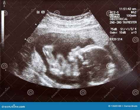 Ultrasound During Second Trimester Stock Photo - Image of sonar, medical: 13605188