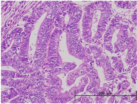 Adenocarcinoma: Endometrial Adenocarcinoma Grade 1