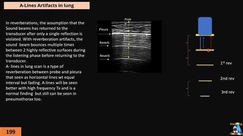 Artifact in Ultrasound 3: Reverberation II - YouTube