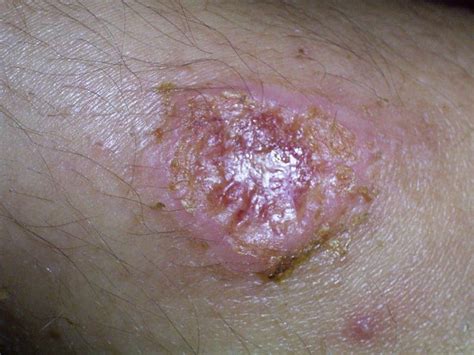 10 Parasitic Infections That Will Terrify You