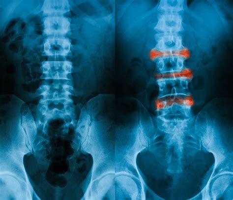 Psoriatic Spondyloarthritis Burden is Similar to Ankylosing Spondylitis