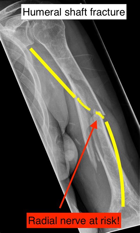 Nerve injury after fracture or dislocation