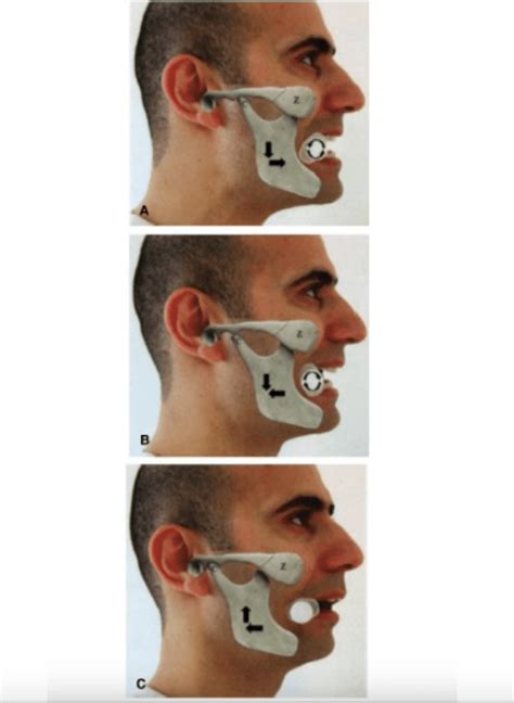 Temporomandibular Joint (TMJ) Dislocation – Core EM