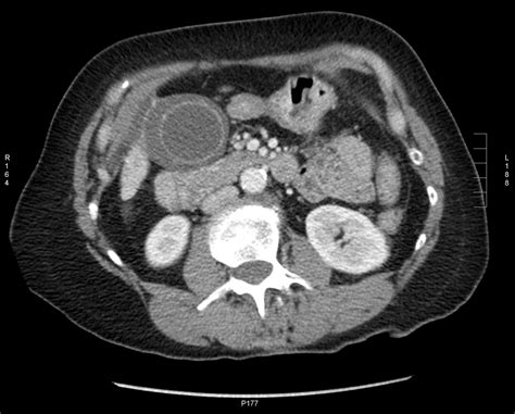 Abdominal CT scan. Causes, symptoms, treatment Abdominal CT scan