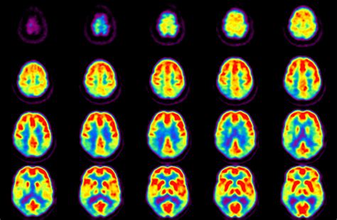 Indications of Brain PET Scan - MEDizzy