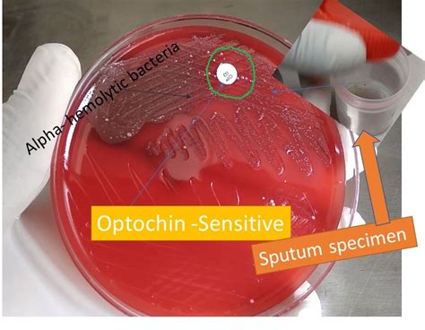 Use of optochin in blood agar during sputum inoculation - universe84a