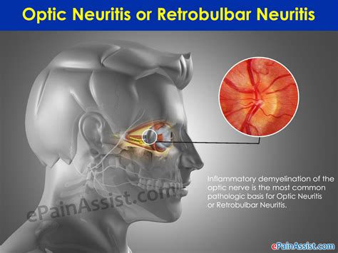 Optic Neuritis or Retrobulbar Neuritis | Causes | Signs | Treatment | Epidemiology