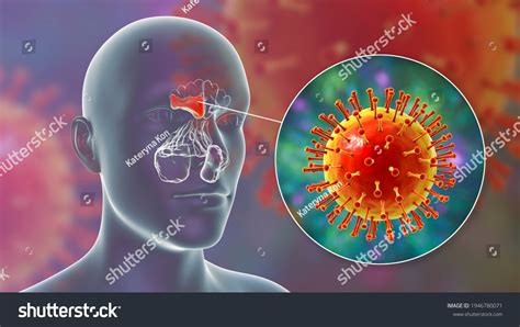 Viral Sinusitis Inflammation Paranasal Cavities 3d Stock Illustration ...