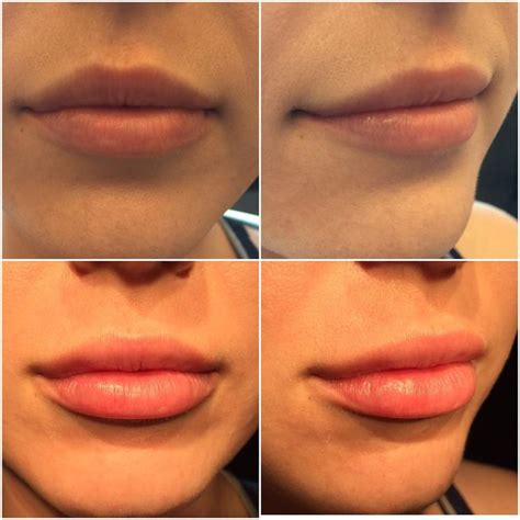 1/2 syringe Juvederm Ultra Plus XC. | Lip fillers cost, Juvederm lips, Lip fillers