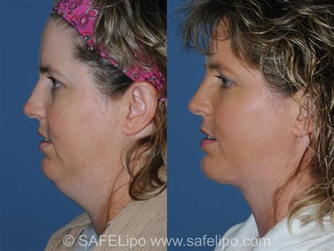 Double Chin Reduction Before and After Pictures Case 350 | SAFELipo®