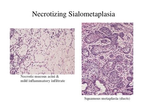 Salivary gland pathoology 1