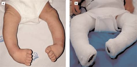 In pes equinovarus deformity (a), the image of long leg casting (b)... | Download Scientific Diagram