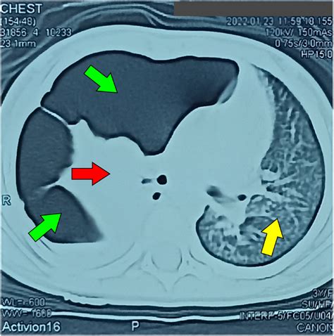 Axial CT of the chest with lung windows, showing a large pneumatocele... | Download Scientific ...