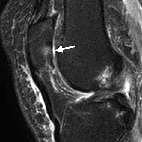 Articular Cartilage in the Knee: Current MR Imaging Techniques and Applications in Clinical ...