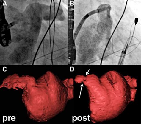 Left Atrial Appendage Remodeling After Lariat Left Atrial Appendage Ligation | Circulation ...