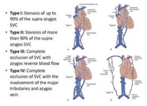 Endovascular Treatment of Superior Vena Cava Syndrome | VDM