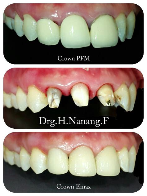 Replacement old crown PFM with Crown Emax Dentistry, Replacement, Crown, Cosmetics, Breakfast ...