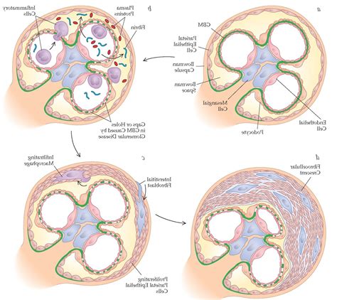 Glomerular Diseases Part 3 from Glomerular Basement Membrane Disease | Pendidikan, Biologi