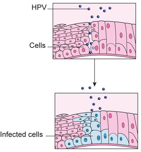 HPV and Cervical Cancer | Jo's Cervical Cancer Trust