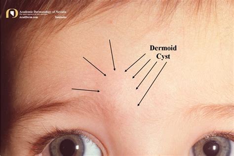 Dermoid Cysts: Once Upon A Time... - Academic Dermatology of Nevada