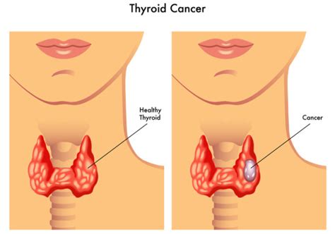 Seek Help for Thyroid Cancer Symptoms—and Find a Cure - University Health News