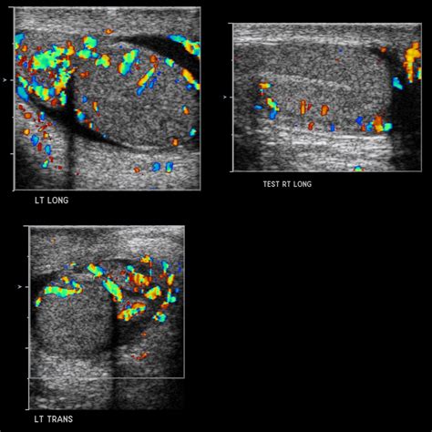 School ager with left testicular pain and swelling | Pediatric Radiology Case | Pediatric ...