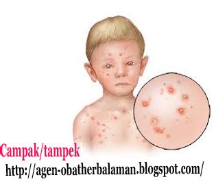 Obat Herbal Campak Pada Anak ~ Obat Herbal Hematuria Aman dan Ampuh AgaricPro