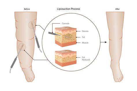 Lymphedema Surgery - Treatment - Siteman Cancer Center