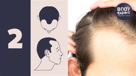 Norwood-Hamilton scale: the 7 stages of male pattern baldness