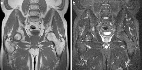 a, b A 63-year-old man with multiple myeloma. MR images of the pelvis... | Download Scientific ...