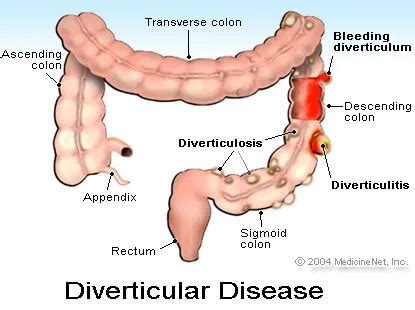 5 Diverticulitis Symptoms, Pain, Diet, Treatment, and Surgery