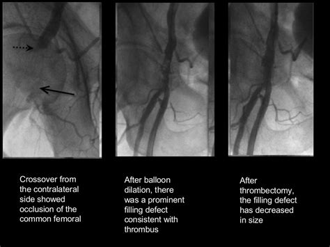 Cardiac cath complications