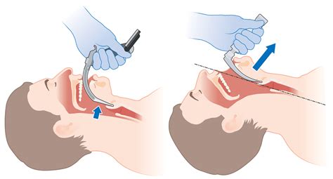 Laryngoscope Medical Infographic