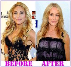 Celebrities Plastic Surgery Before and After