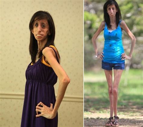 The Skinniest Person in The World Guinness World Record images