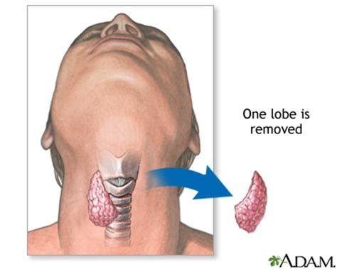 Cricoid Thyroidectomy Diet