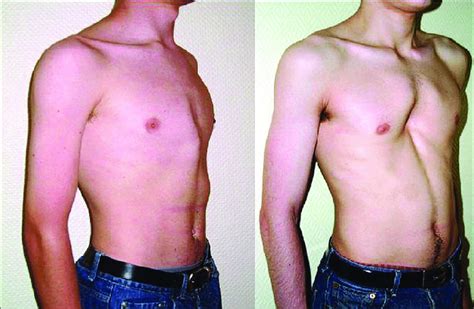 Pectus Excavatum And Carinatum | Hot Sex Picture