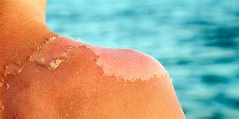 Sunburn Peeling Causes Plus Skin Remedies to Heal Faster