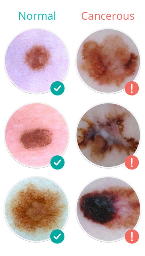 Melanoma Skin Moles