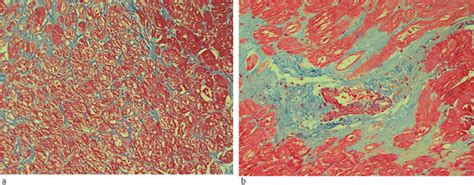 Myocardial fibrosis | Tidsskrift for Den norske legeforening