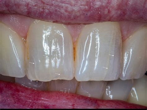 Lines on teeth | Worried about the craze lines on your front teeth?