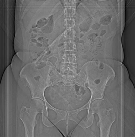 Intestinal malrotation | Image | Radiopaedia.org