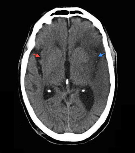 Insular ribbon sign - refers to loss of the normal insular cortex grey-white differentiation and ...