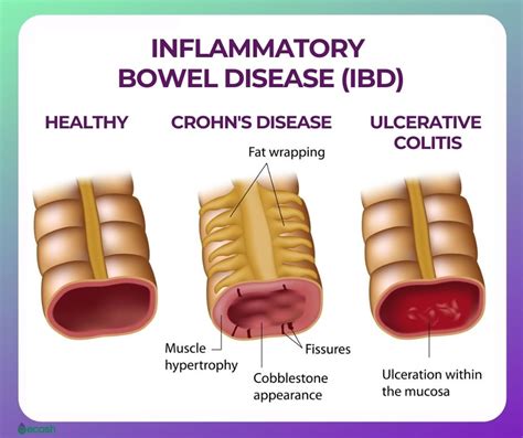 ULCERATIVE COLITIS (UC) - Symptoms, Causes, Risk Factors, Ulcerative Colitis Diet, Lifestyle ...